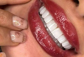 لمینت سرامیکی