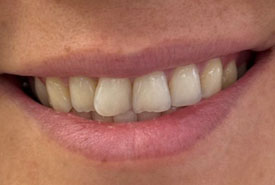 کامپوزیت ونیر (قبل)