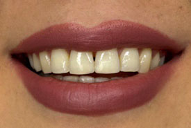 کامپوزیت ونیر (بعد)