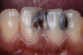 کامپوزیت ونیر (قبل)