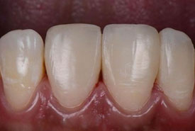 کامپوزیت ونیر (بعد)