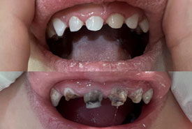 عصب کشی (پالپکتومی) و ترمیم