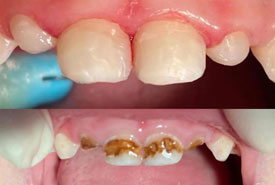 درمان چهار دندان