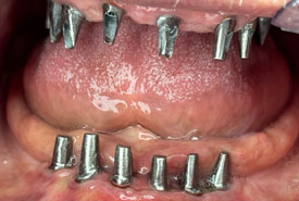 ایمپلنت (قبل)