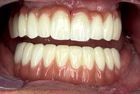 ایمپلنت (بعد)