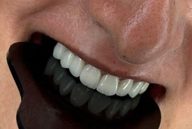 لمینیت سرامیکی (نمونه 1)