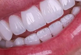 لمینیت سرامیکی (نمونه 2)