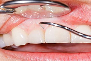 جراحی دندان نهفته