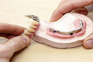 پروتزهای دندانی