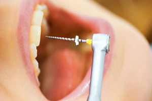 درمان ریشه (عصب کشی)